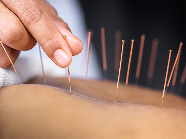 Why Migraine Patients are Seeking Acupuncture Near Me