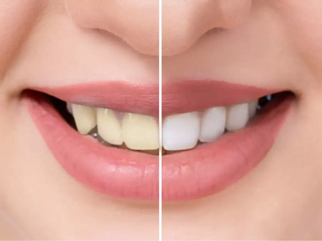 What are Important Ways to Keep Your Teeth White and Bright? 